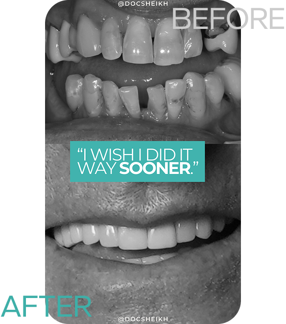 before and after (1)
